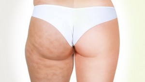 cellulite